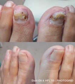 De Nummer 1 Tegen Schimmelnagels! - HFL - Laboratories - Solution Spray - 50ml + Dadi'Oil Nagelriem Olie - 3.75ml - Kalknagel Spray - Schimmelnagel Spray - Nagelriem Olie - Nagelverzorging -Verzorgingsproducten Verkoop 1065x1200