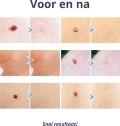 Steelwratjes Verwijderaar - Steelwratjes Verwijderen - Pijnloos En Snel - Wrattenverwijderaar - Steelwratten 11 Steelwratjes Verwijderaar - Steelwratjes Verwijderen - Pijnloos En Snel - Wrattenverwijderaar - Steelwratten -Verzorgingsproducten Verkoop 1148x1200