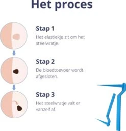 Steelwratjes Verwijderaar - Steelwratjes Verwijderen - Pijnloos En Snel - Wrattenverwijderaar - Steelwratten 10 Steelwratjes Verwijderaar - Steelwratjes Verwijderen - Pijnloos En Snel - Wrattenverwijderaar - Steelwratten -Verzorgingsproducten Verkoop 1154x1200