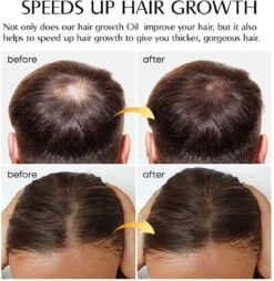 Haarserum - Haargroei Stimulator - Tegen Haaruitval - Baardgroeimiddel - Baardgroei Olie - Alternatief Voor Minoxidil 5% 10 Haarserum - Haargroei Stimulator - Tegen Haaruitval - Baardgroeimiddel - Baardgroei Olie - Alternatief Voor Minoxidil 5% -Verzorgingsproducten Verkoop 1167x1200 3