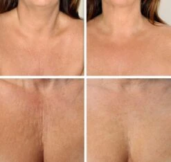 Simia™ Anti Rimpel Beauty Pads - Decolleté Large T Shape Set (2 Stuks) - Herbruikbaar Anti Aging Siliconen Pad Tegen Lijntjes En Slaaprimpels -Verzorgingsproducten Verkoop 1200x1139 2