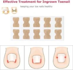 Merkloos Ingegroeide Teennagel Corrector -Verzorgingsproducten Verkoop 1200x1146