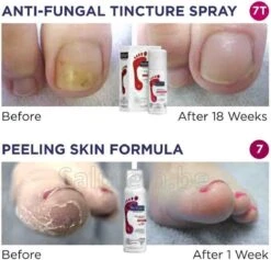 Footlogix Toe Nail Tincture Nagelspray 9 Footlogix Toe Nail Tincture Nagelspray -Verzorgingsproducten Verkoop 1200x1150 1