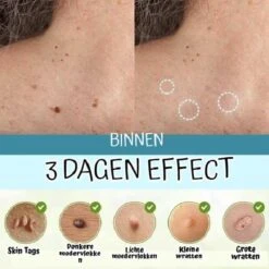 Skini™ - Moedervlekken & Wratten & Skin Tags Verwijderaar | Moedervlekken Verwijderaar | Wratten Verwijderaar | Moedervlekken Verwijderen | Wratten Verwijderen | Fibroom Verwijderen | Skin Tag Verwijderen | Steelwratjes Verwijderen -Verzorgingsproducten Verkoop 1200x1200 591