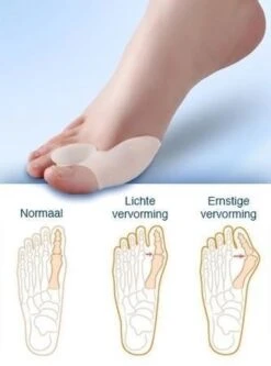 MYCARE+ Teencorrector - Wasbare Teencorrector - Gel-laag - 1 Paar - Pijn Verlichtend -Verzorgingsproducten Verkoop 890x1200 2