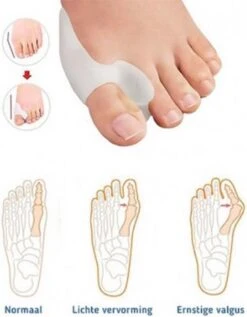 MYCARE+ Teencorrector - Wasbare Teencorrector - Gel-laag - 1 Paar - Pijn Verlichtend -Verzorgingsproducten Verkoop 936x1200