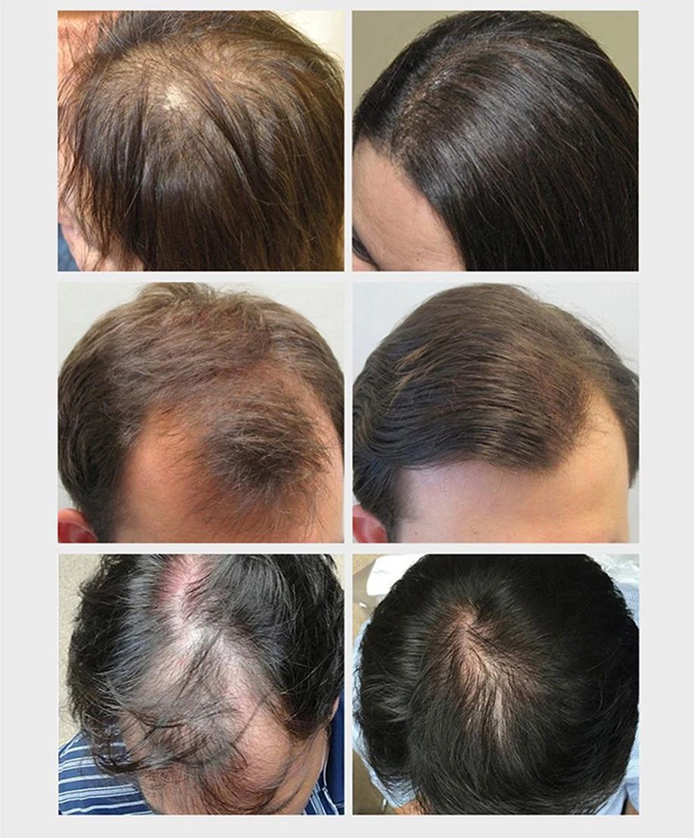 Haarserum 7days | Haarkuur 7daags | Haaruitval Bestrijden | Gember Extracten Voor Stimuleren Haargroei | Haar Olie | Bewezen Formule 4 Haarserum 7days | Haarkuur 7daags | Haaruitval Bestrijden | Gember Extracten Voor Stimuleren Haargroei | Haar Olie | Bewezen Formule - Afbeelding 2