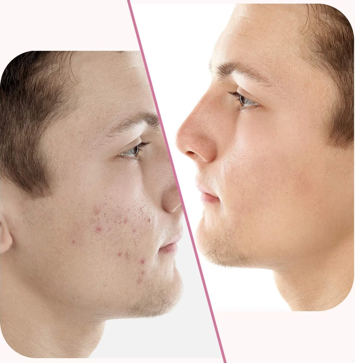 Merkloos Pimple Patch - Acne Patch - Puisten Patch - Acne Sticker - Puisten Pleister - Pimple Patches - Acne Pleister - Puisten Verwijderaar - Puisten Creme - Acne Verwijderen Set - Acneverzorging | 36 Stuks & Directe Levering 5 Merkloos Pimple Patch - Acne Patch - Puisten Patch - Acne Sticker - Puisten Pleister - Pimple Patches - Acne Pleister - Puisten Verwijderaar - Puisten Creme - Acne Verwijderen Set - Acneverzorging | 36 Stuks & Directe Levering - Afbeelding 3