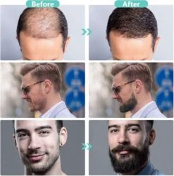 Dermaroller 0.5 Mm & Desinfectie Alcohol Spray - 540 Naalden - Steriel Verpakt -Verzorgingsproducten Verkoop 1190x1200 3