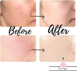 Derma Roller - 540 Needle - 0.5 MM Naald - Steriel Verpakt - Skin Roller - Huid Verzorging - Huidverzorging - Dermaroller - Baardgroei Stimuleren - HaarGroei Stimulatie - Haar En Huid - Strakke Huid - Acné - Puisten - Striae - Littekens -Verzorgingsproducten Verkoop 1200x1105 2