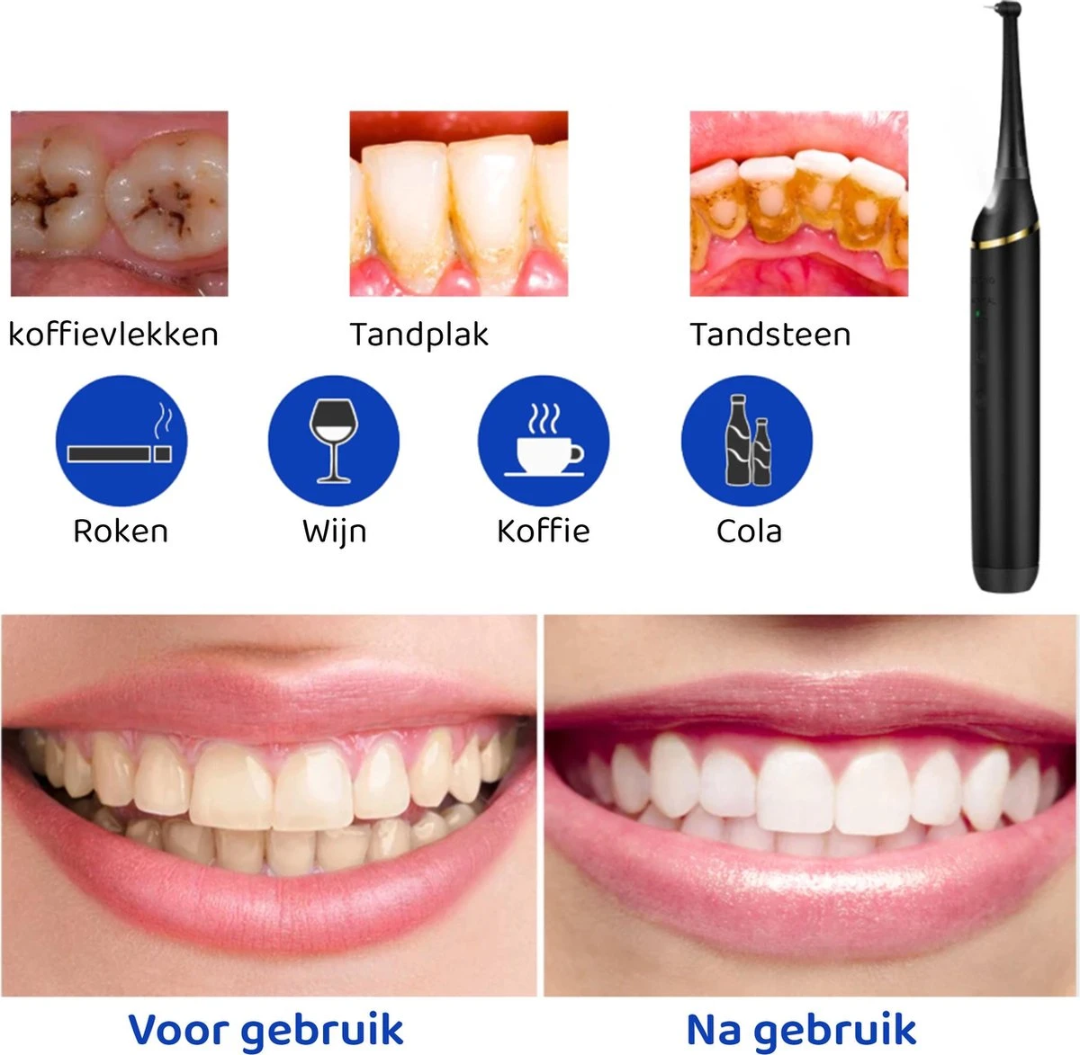 ExCorn Elektrische Tandsteen Verwijderaar - Inclusief 6-delig Tandartsset - 3 Standen - Elektrisch Tandplak Verwijderen - Tanden Polijsten 6 ExCorn Elektrische Tandsteen Verwijderaar - Inclusief 6-delig Tandartsset - 3 Standen - Elektrisch Tandplak Verwijderen - Tanden Polijsten - Afbeelding 4