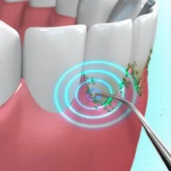 Toppers Van TV - Sonic Tandsteenverwijderaar - Tandplakverwijderaar -Verzorgingsproducten Verkoop 1200x1200 262