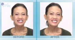 Tand Afgebroken Reparatie Kit InstantSmile Gebit (goedkope Kunstgebit) - Multi Shade -Verzorgingsproducten Verkoop 1200x639