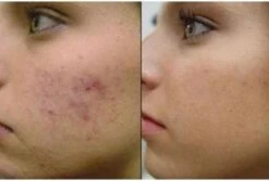 Merkloos Dermaroller 0.3mm Needle - Micro Needling Roller - Anti Acne/Cellulitis/Rimpels/Littekens/Striae Lichaams & Gezichts Roller 9 Merkloos Dermaroller 0.3mm Needle - Micro Needling Roller - Anti Acne/Cellulitis/Rimpels/Littekens/Striae Lichaams & Gezichts Roller -Verzorgingsproducten Verkoop 1200x809 1