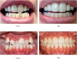 Edoir Rechte Tanden Beugel - Retainer Voor Rechte Tanden - Rechte Tanden Bitje -Verzorgingsproducten Verkoop 1200x929