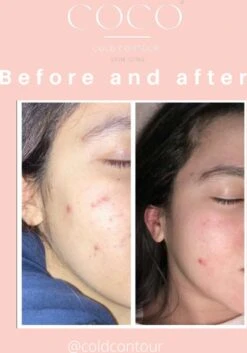 COLDCONTOUR - Skin Ice Roller Gezicht- Facial Icing- Roze - Aftersun- Cadeautip - Anti Rimpel- Ice Globes - Ijs Gezicht - Gezichtsmassage Roller - Huidverjongingsapparaat - Anti Aging- Cadeau 37 COLDCONTOUR - Skin Ice Roller Gezicht- Facial Icing- Roze - Aftersun- Cadeautip - Anti Rimpel- Ice Globes - Ijs Gezicht - Gezichtsmassage Roller - Huidverjongingsapparaat - Anti Aging- Cadeau -Verzorgingsproducten Verkoop 839x1200