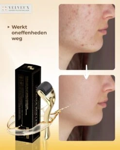 Dermaroller – 540 Micro Naalden – 0.5 MM Needle – Huidverjonging – Huidverzorging – Littekens – Striea – Steriel Verpakt -Verzorgingsproducten Verkoop 960x1200 31